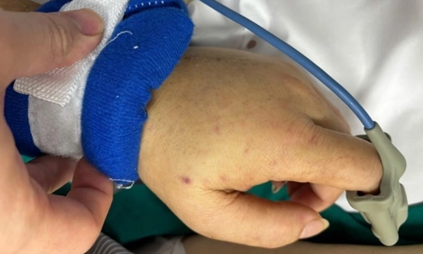 Cà Mau ghi nhận 3 ca nghi mắc bệnh viêm não mô cầu